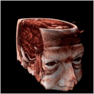 Bob's MRI